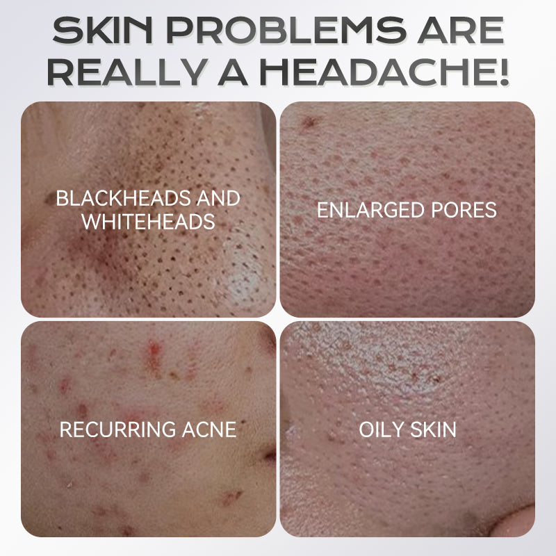 Stick Maschera all'Argilla all'Acido Azelaico 40 g