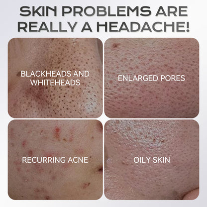 Stick Maschera all'Argilla all'Acido Azelaico 40 g