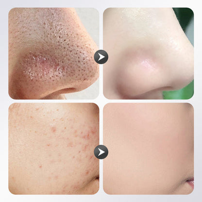 Stick Maschera all'Argilla all'Acido Azelaico 40 g