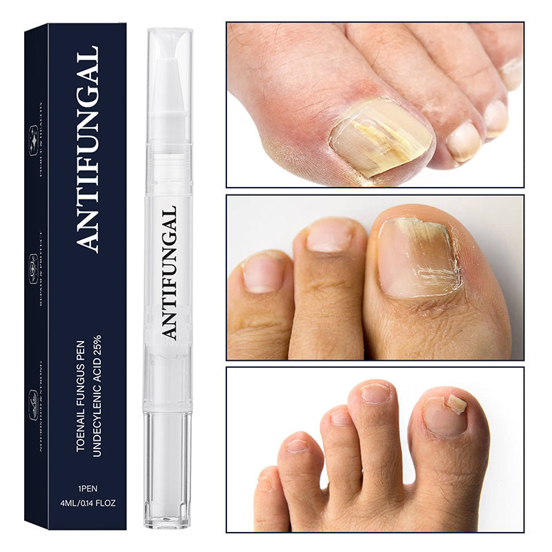 💅🔥ACQUISTA 2, OTTIENI 3 GRATIS! ✨ Penna per Trattamento di Micosi alle Unghie – Azione Rapida, Applicazione Precisa & Effetto Lenitivo 🦶