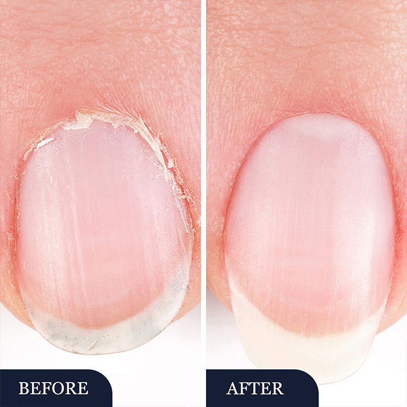 💅🔥ACQUISTA 2, OTTIENI 3 GRATIS! ✨ Penna per Trattamento di Micosi alle Unghie – Azione Rapida, Applicazione Precisa & Effetto Lenitivo 🦶