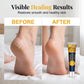 🥳2026 SUPER OFFERTA🥳💞50K+ VENDUTI! 🦶💚 PRENDI 2 PAGHI 1! Crema Piedi Intensiva – idratazione profonda per talloni secchi e screpolati. Gli estratti vegetali riparano e ammorbidiscono: assorbimento rapido, zero effetto unto! 🌿✨